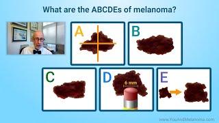 What are the signs and symptoms of melanoma?