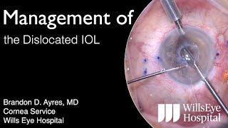 Management of Dislocated IOLs