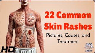 22 Skin Rashes Everyone Should Know About Symptoms & Treatments