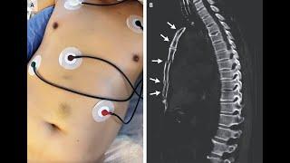 Instabiler Thorax