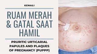 Ruam Merah & Gatal - Gatal Pada Kehamilan