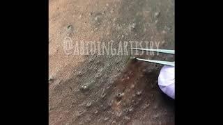 Ingrown Hair Extraction Video 3