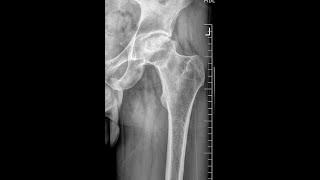 Osteoartrit - osteoarthritis