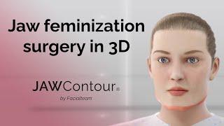 JAWContour®  3D Precision in Jaw and Chin Feminization Surgery