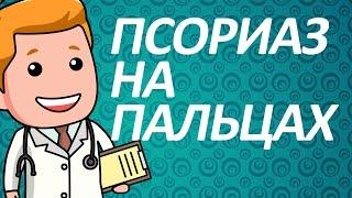 Псориаз на пальцах рук. Как лечить псориаз на руках?