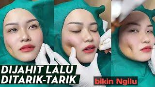 Viral video pembuatan lesung pipibikin ngilu