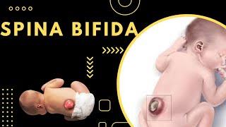 Spina Bifida  Causes Symptoms and Treatment
