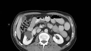 small bowel obstruction with volvulus