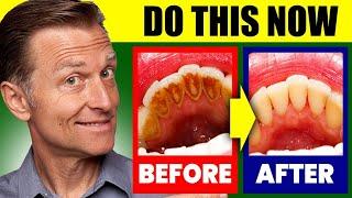 Natural Solution for Plaque Cavities and Gingivitis