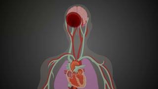 Cómo Prevenir una Apoplejía por Fibrilación Auricular