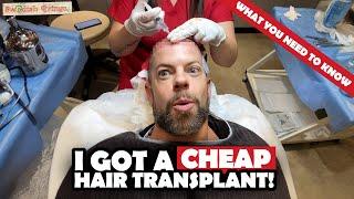 I Got a Cheap Hair Transplant in Turkey – This Happened  FILMED SURGERY & FIRST 6 WEEKS