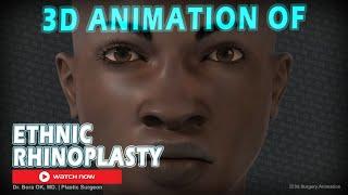 Dr. Bora Ok MD. - 3D Animation Of Ethnic Rhinoplasty Surgery