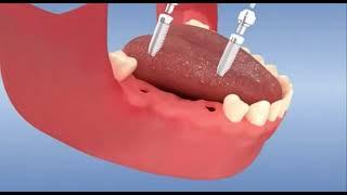 Implants dentaires SANS chirurgie - flapless