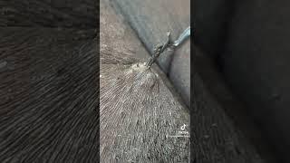 MASSIVE INGROWN HAIR #ingrownhair #extractionsatisfaciton #ingrownhairremoval #pimplepopping