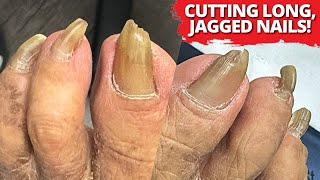 1 Year Without Cutting Extreme Thick Nail & Callus Trimming