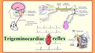 trigeminocardiac reflex
