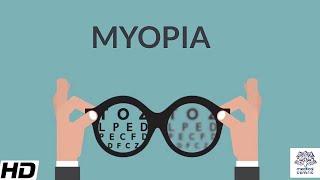 Myopia Signs and Symptoms Causes Diagnosis and Treatment.