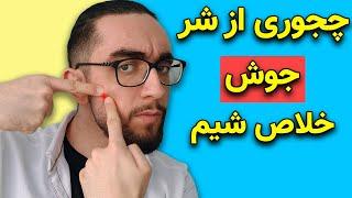 چجوری یک شبه از شر جوش خلاص شیم  درمان سریع جوش صورت