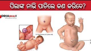 ପିଲା ଜନ୍ମ ବେଳେ ନାଭି ପାଚିଗୋଲ କଣ କରିବ ଉଚିତ୍?  Pila ra nabhi pachile kana karibe? Odia health tips