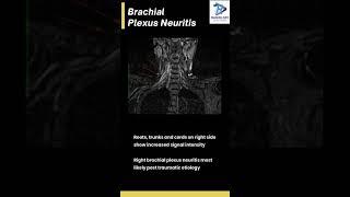 Brachial plexus neuritis