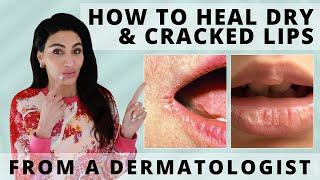 How to Heal Dry & Cracked Lips Fast  Dermatologist Reveals