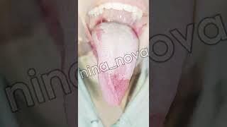 White tongue fungs sick girl