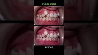 Crooked Braces 28 months