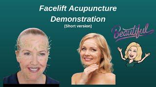 SELF ACUPUNCTURE FACELIFT - An alternative facial rejuvenation procedure.