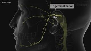 Trigeminal Neuralgia local doctors may have found the cure