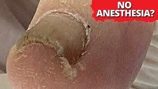 No Anesthesia?  DEEP Ingrown Nail Removal