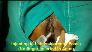 Simplified Easily Reproducible Pudendal Nerve Block Technique for Anorectal surgery SEPTA