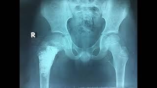 unicameral bone cyst proximal femur  كيس عظمي في الفخذ