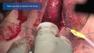 AdVance™ XP Male Sling System surgical video