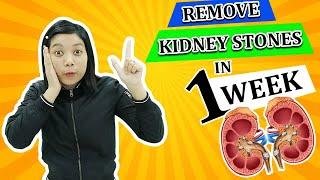 How to Remove Kidney Stones In 1 WEEK  Kidney Expert and Treatment  US UK 