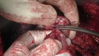 Ovarian Cancer Surgery performed by Pr. Kridelka