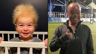 Uncombable Hair Syndrome and Other Rare Genetic Conditions