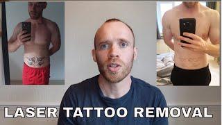 Laser Tattoo Removal  - Sessions 10-12 Update