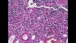 Histopathology Kidney--Acute transplant rejection