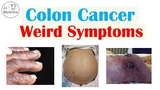 Colon Cancer Weird Symptoms & Why They Occur