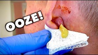 DRAINING AN EAR ABSCESS All the Ooze + Slow Mo Replay   Dr. Paul