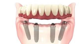 All-on-4 Dental Implants Simple Procedure Animation