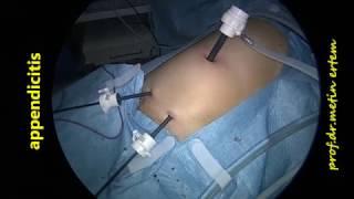 appendicitis