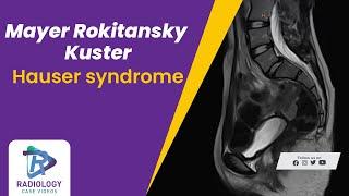 Mayer Rokitansky Kuster Hauser syndrome
