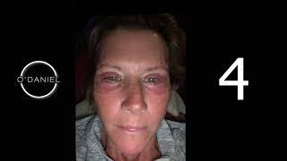 BROWLIFT & EYELIFT - Recovery - 30 DAY TIMELAPSE