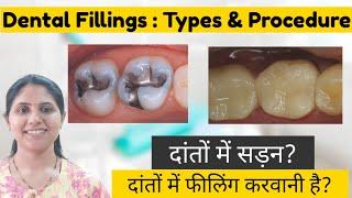 Dental Filling- Types & Procedure