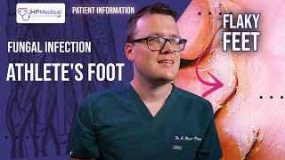 DOCTOR Explains ATHLETES FOOT  Fungal Foot Infection - Itchy Flaky Feet  Tinea Pedis