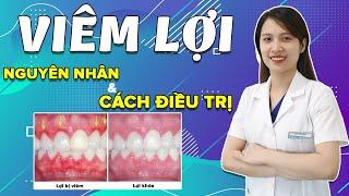 Viêm Lợi  Nguyên Nhân Cảnh Báo Và Cách Điều Trị Hiệu Quả