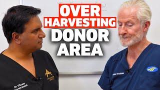 The Problem With Over Harvesting In The Donor Area  The Hair Loss Show