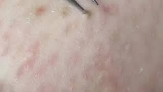 인그로운 헤어뽑기 Ingrown hair.