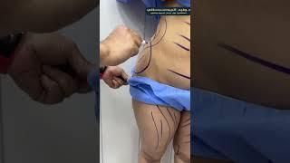 تعالو نشوف حاله النحت بالفيزر رباعي الابعاد  #تجميل #foryou